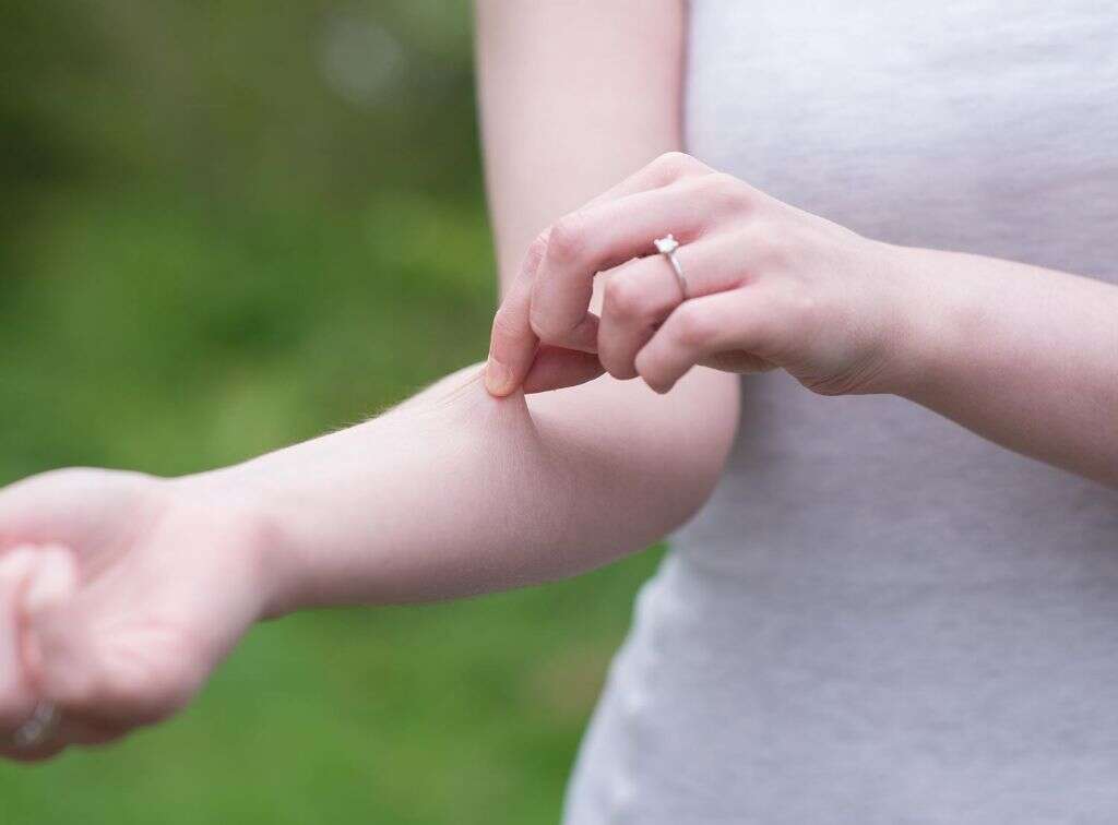 Ehlers Danlos