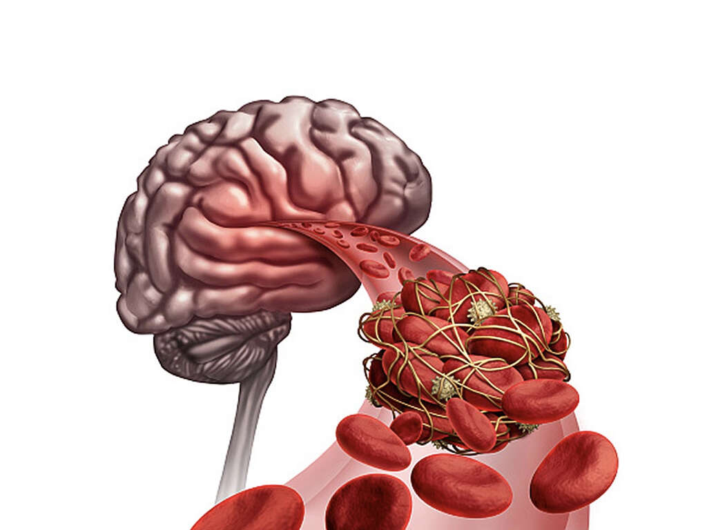 Embolic Stroke