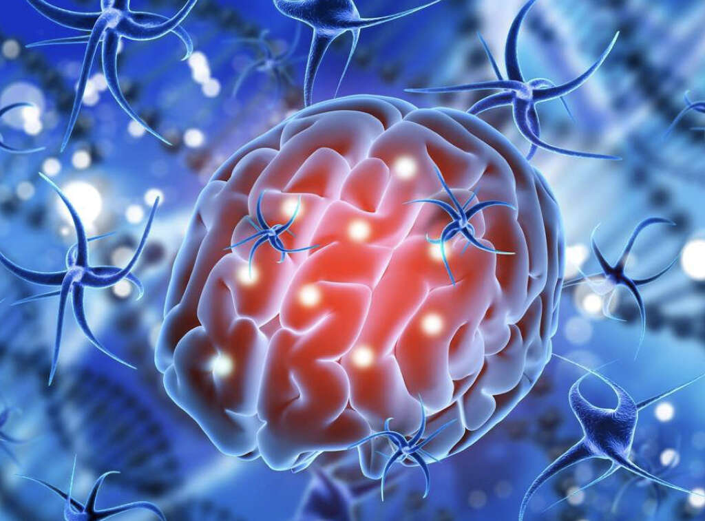 Embolic Stroke