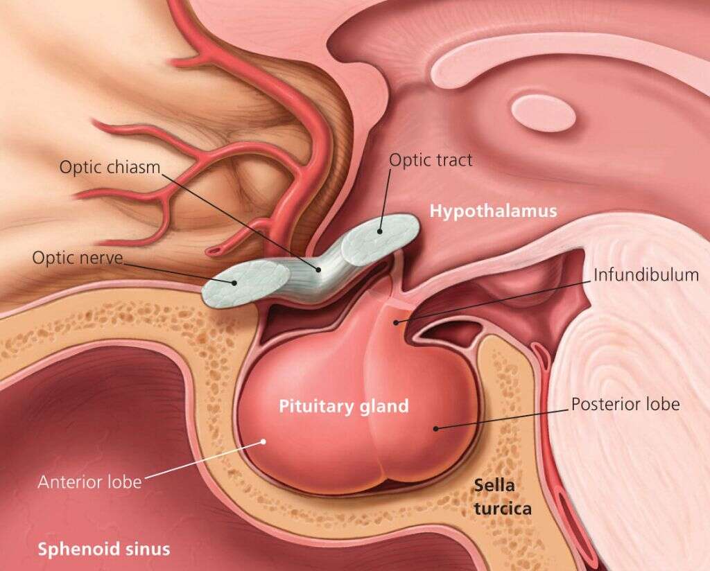 Empty Sella Syndrome