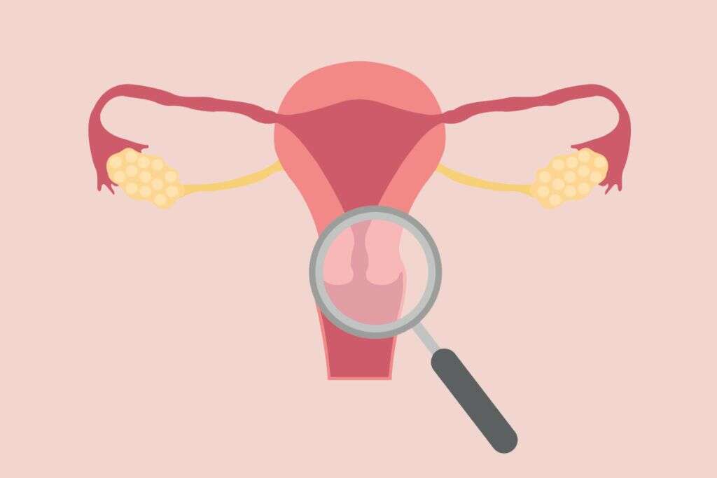 Endometriosis