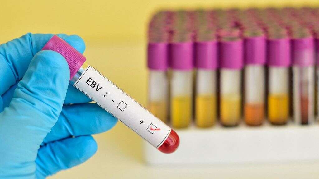 Epstein Barr Virus