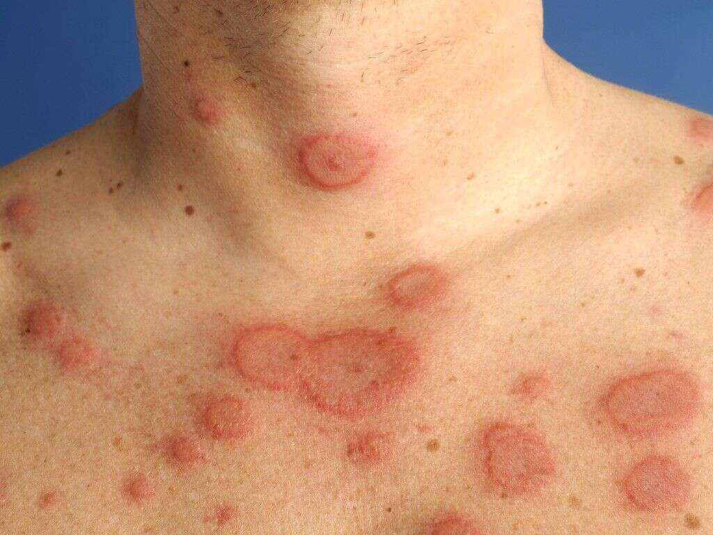 Erythema Multiforme