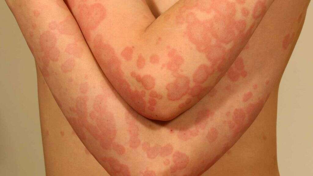 Erythema Multiforme