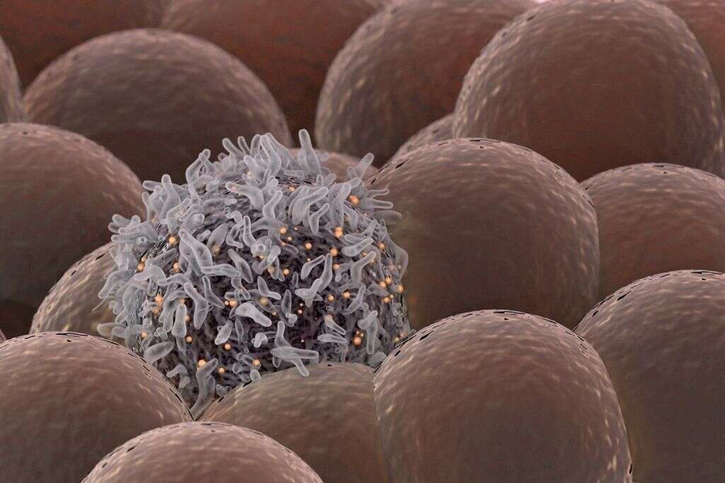 Esophageal Cancer