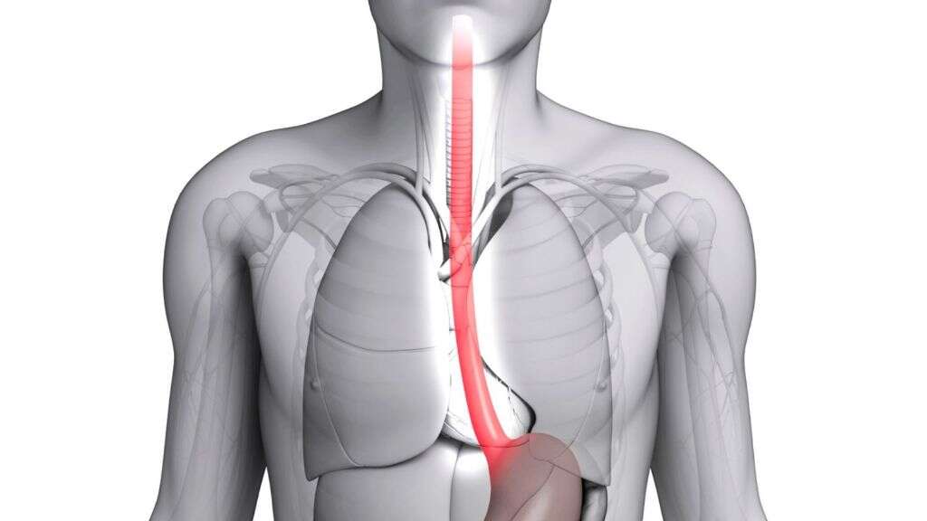 Esophageal Cancer