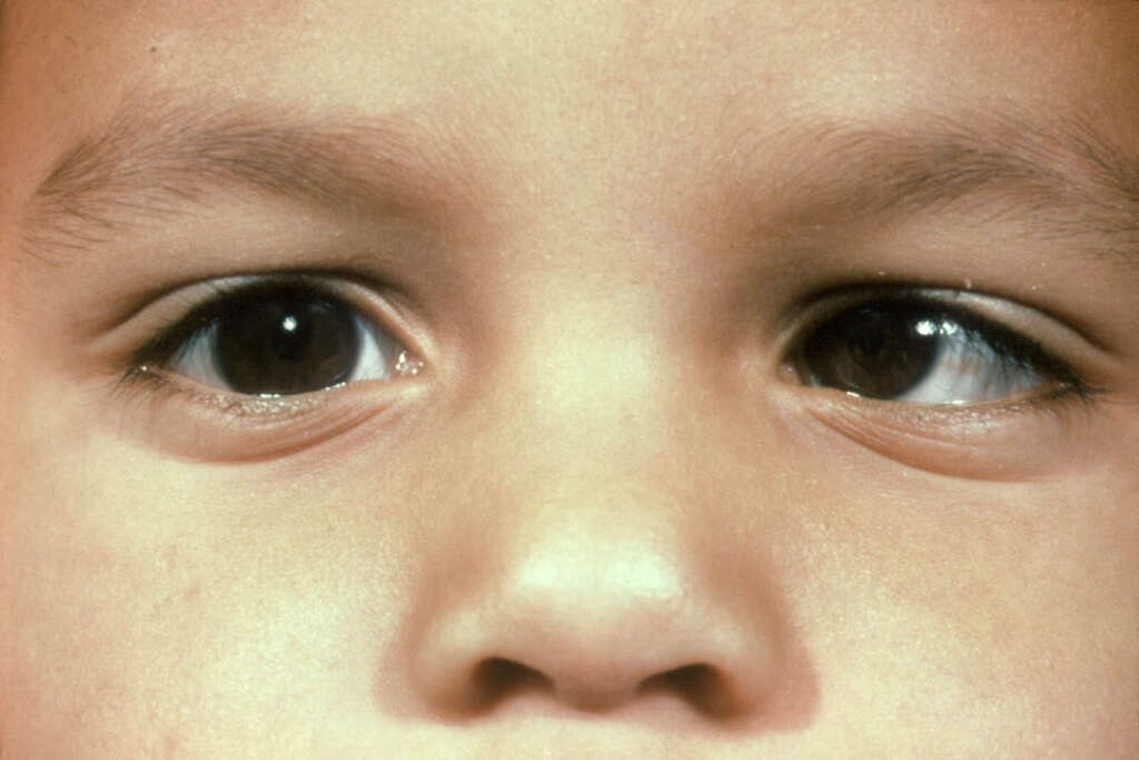 Esotropia