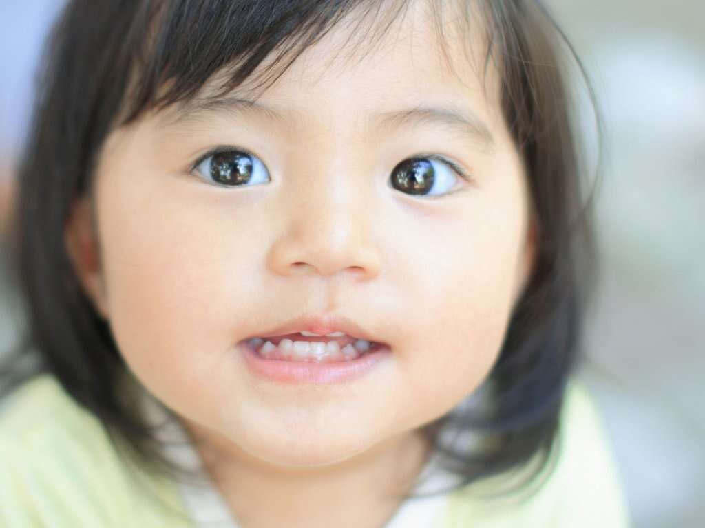 Esotropia