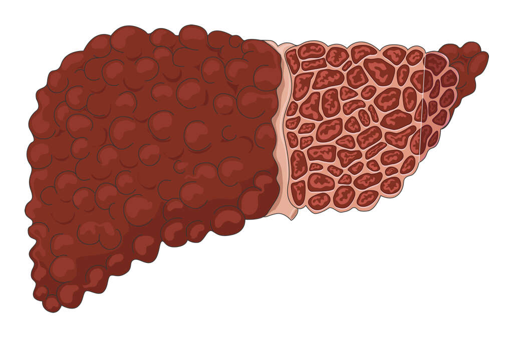 Fatty Liver Disease