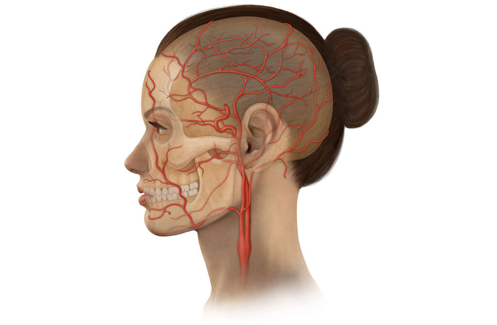 Fibromuscular Dysplasia