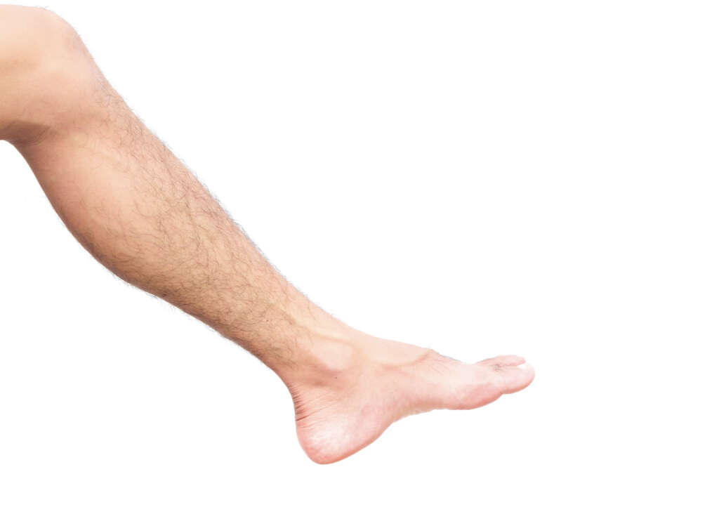 Fibromuscular Dysplasia