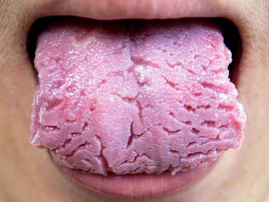 Fissured Tongue