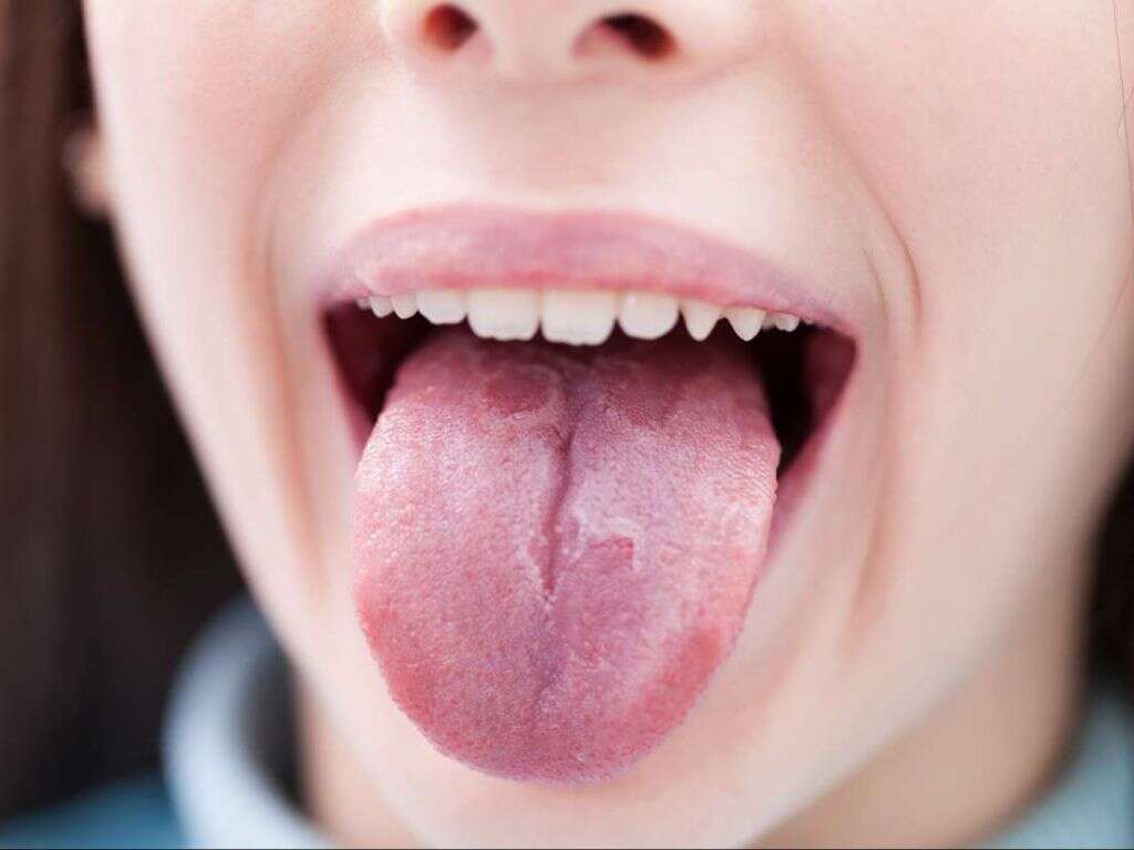 Fissured Tongue