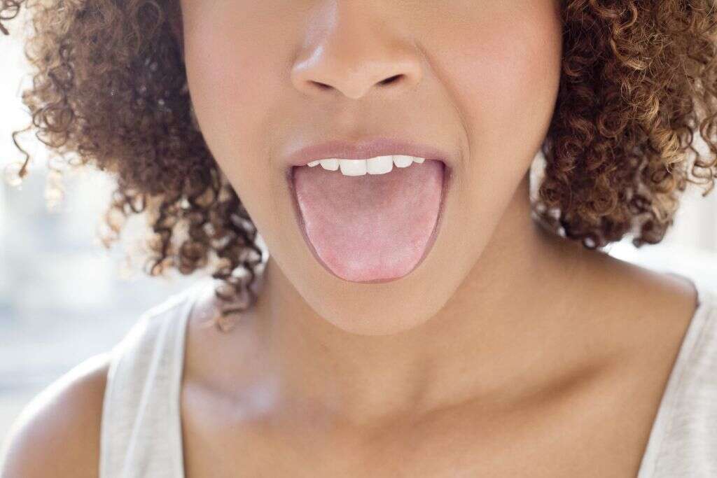 Fissured Tongue