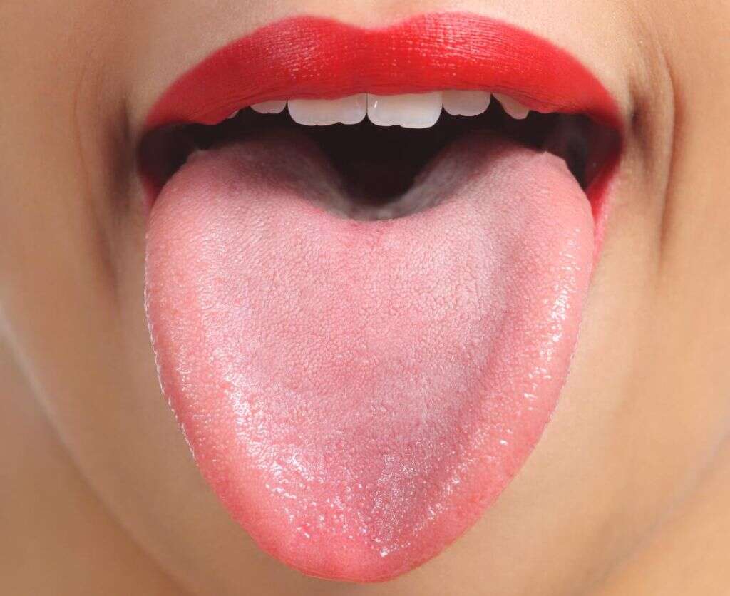 Fissured Tongue
