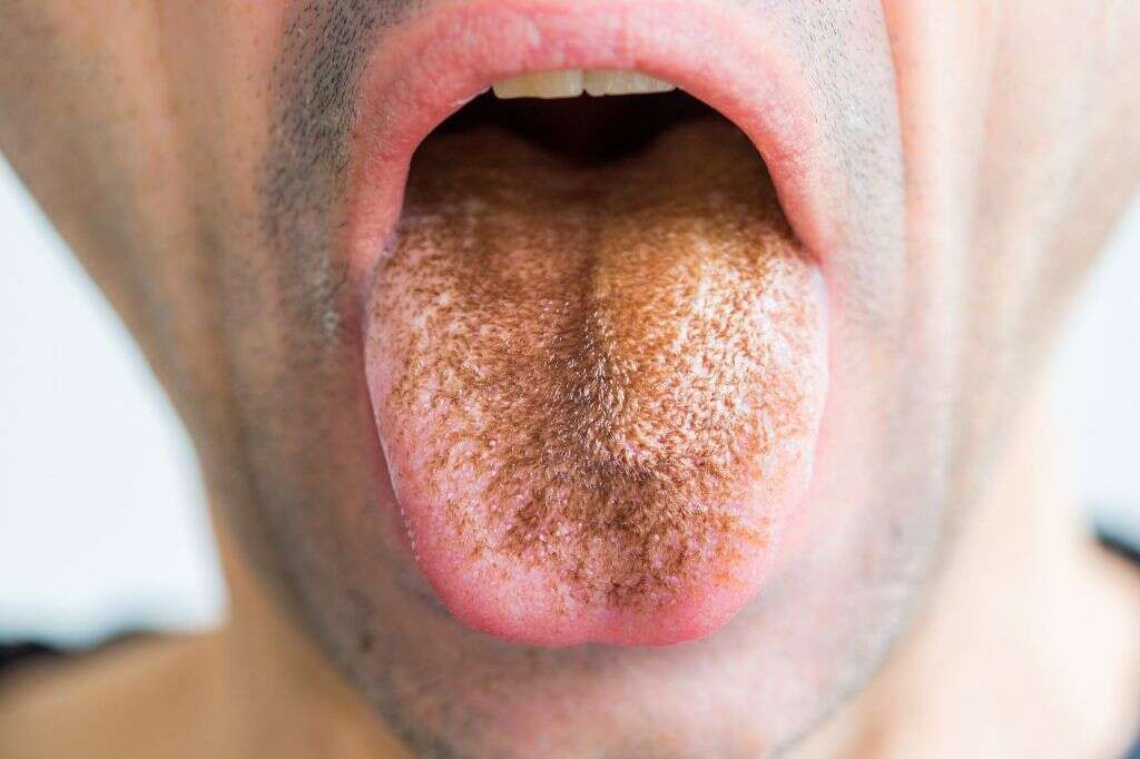Fissured Tongue