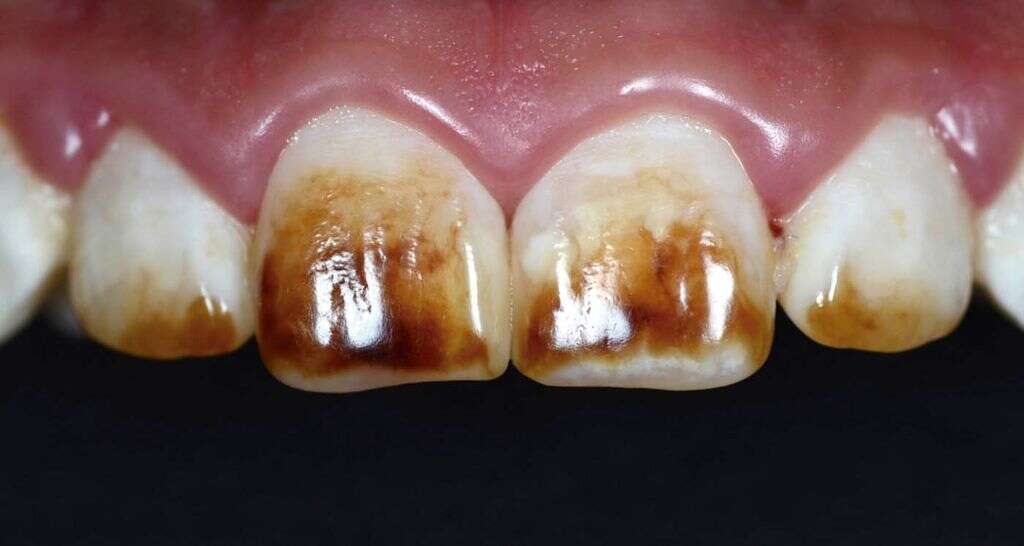 Fluorosis