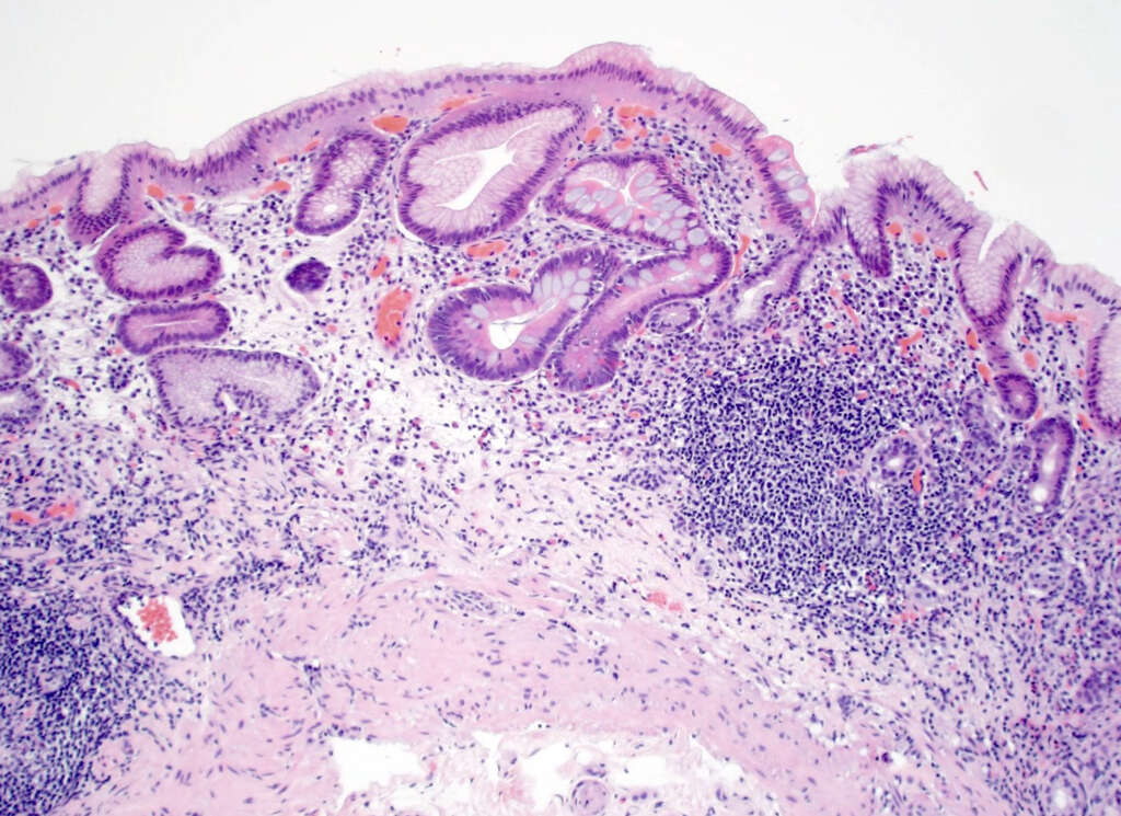 Gastritis