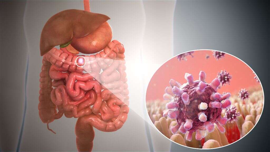 Gastroenteritis