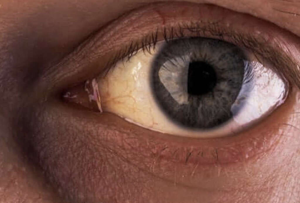 Gilbert Syndrome