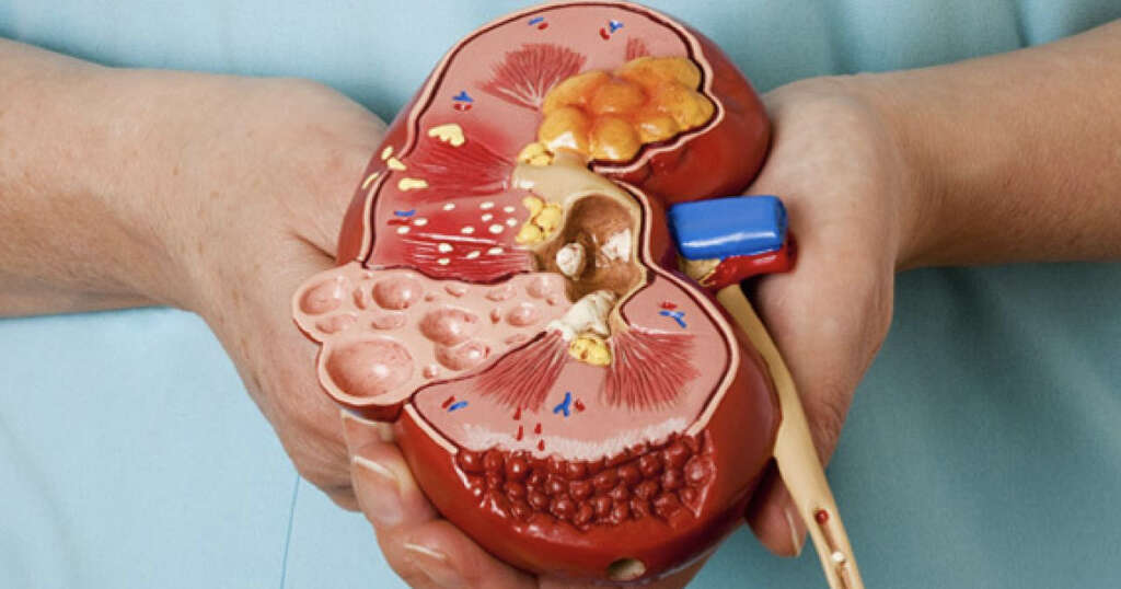 Glomerulonephritis
