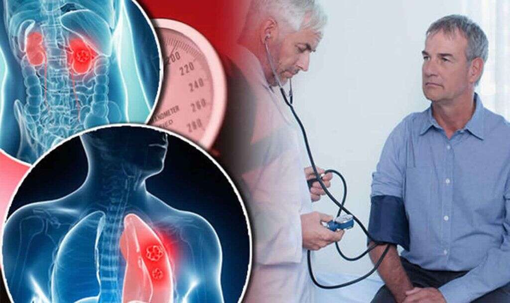 Goodpasture Syndrome