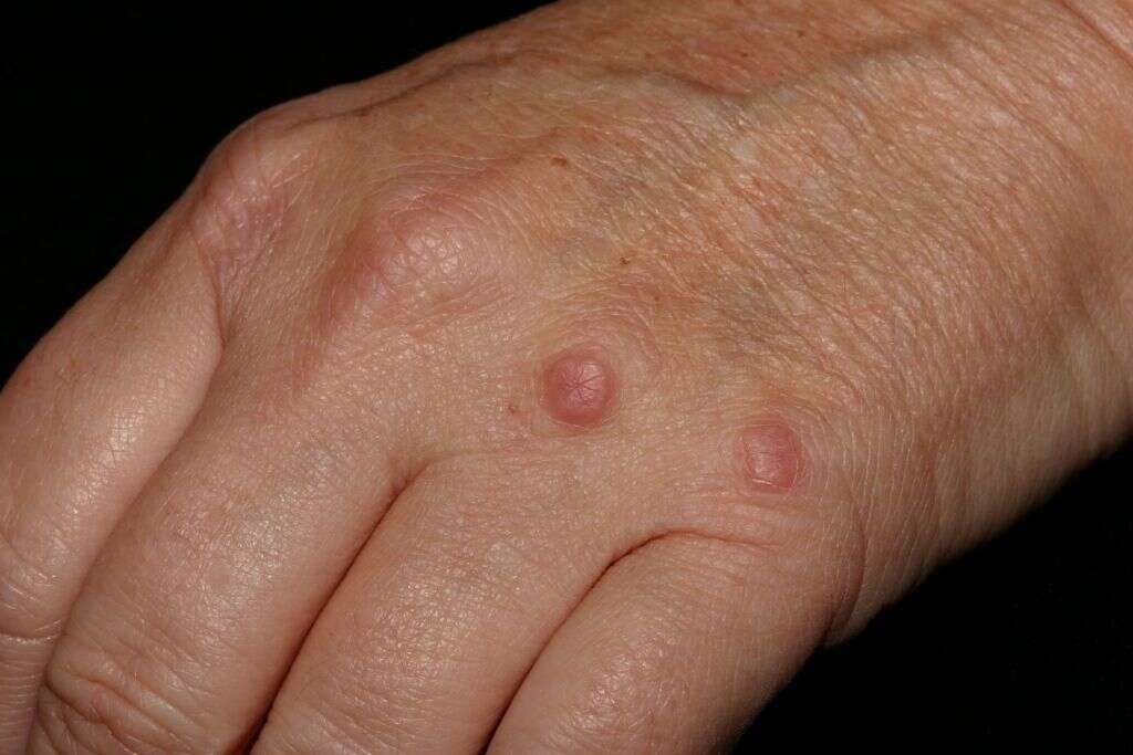 Granuloma Annulare