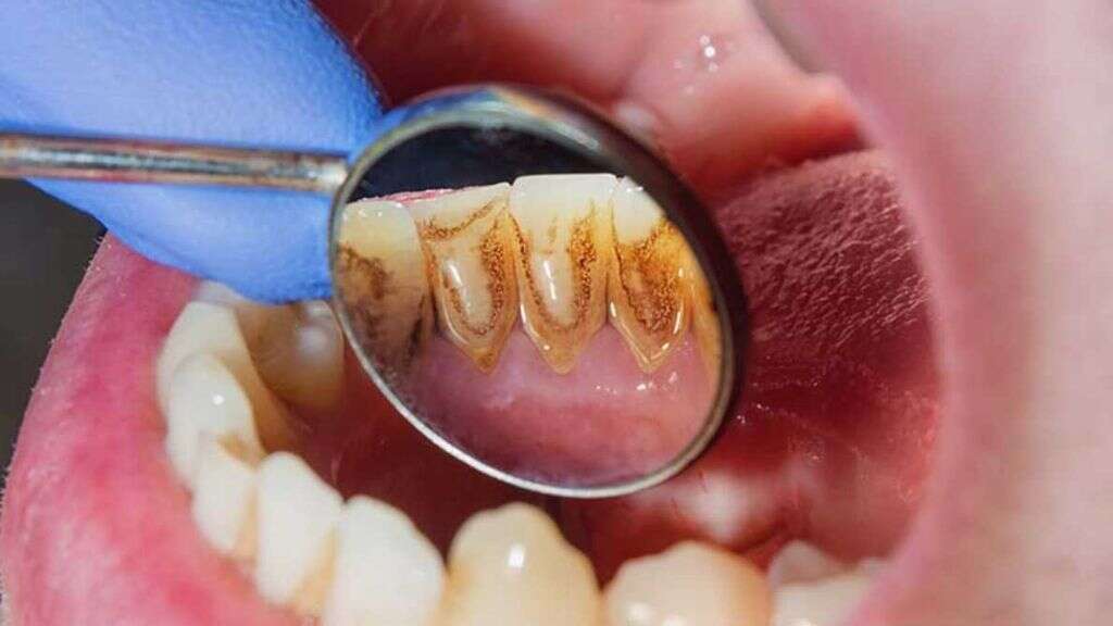 Gum Disease