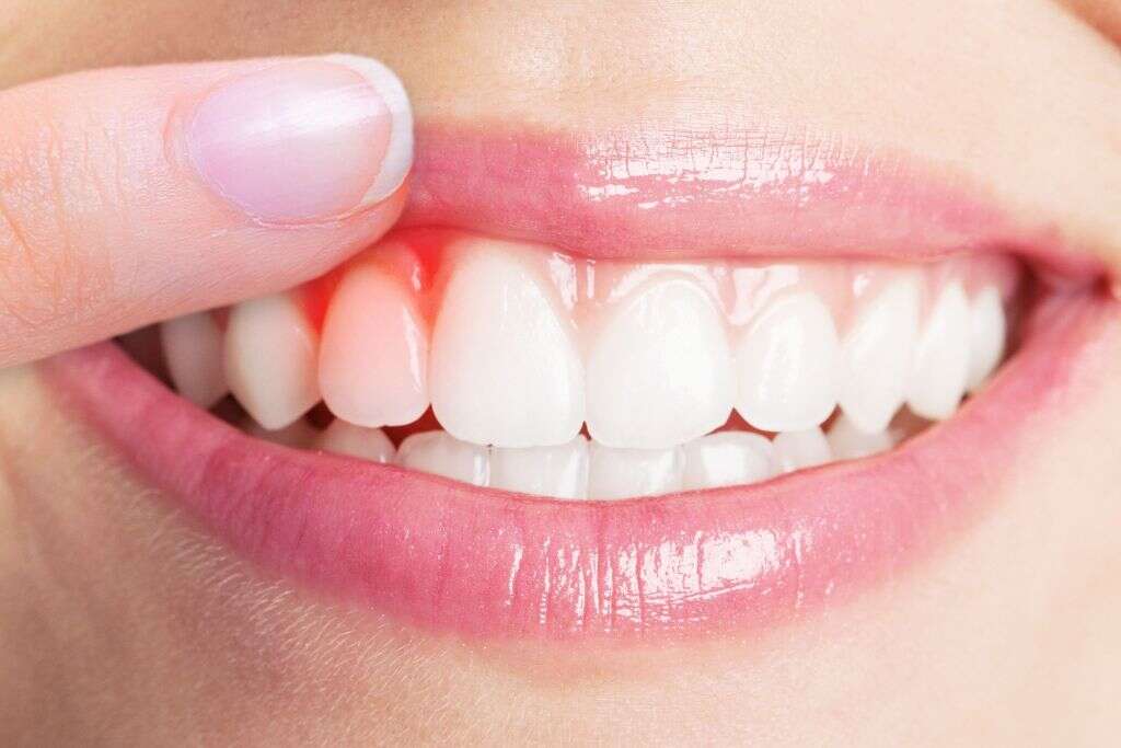 Gum Disease