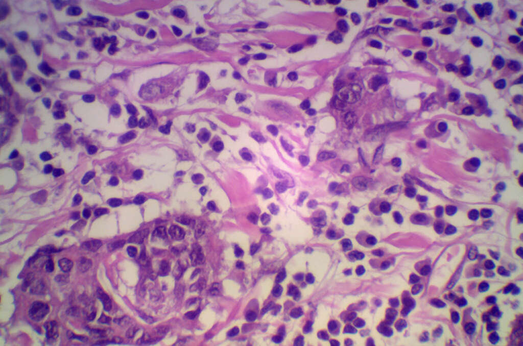 H. Pylori