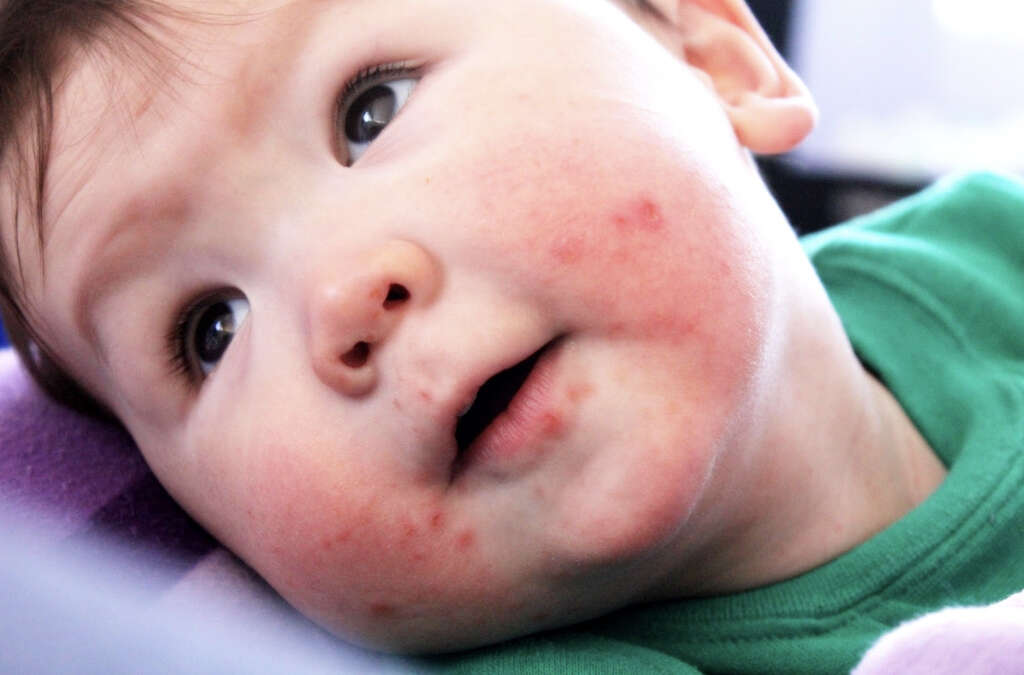 Hand, Foot, and Mouth Disease