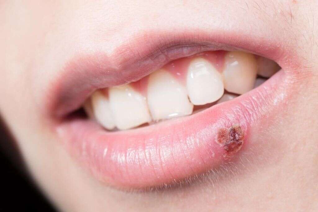 Herpes