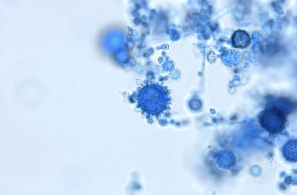 Histoplasmosis