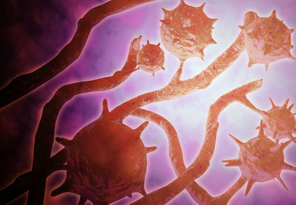 Histoplasmosis
