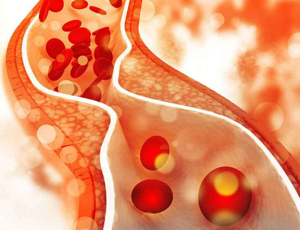 Hyperlipidemia