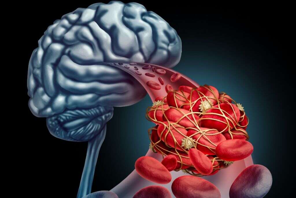 Hyperlipidemia