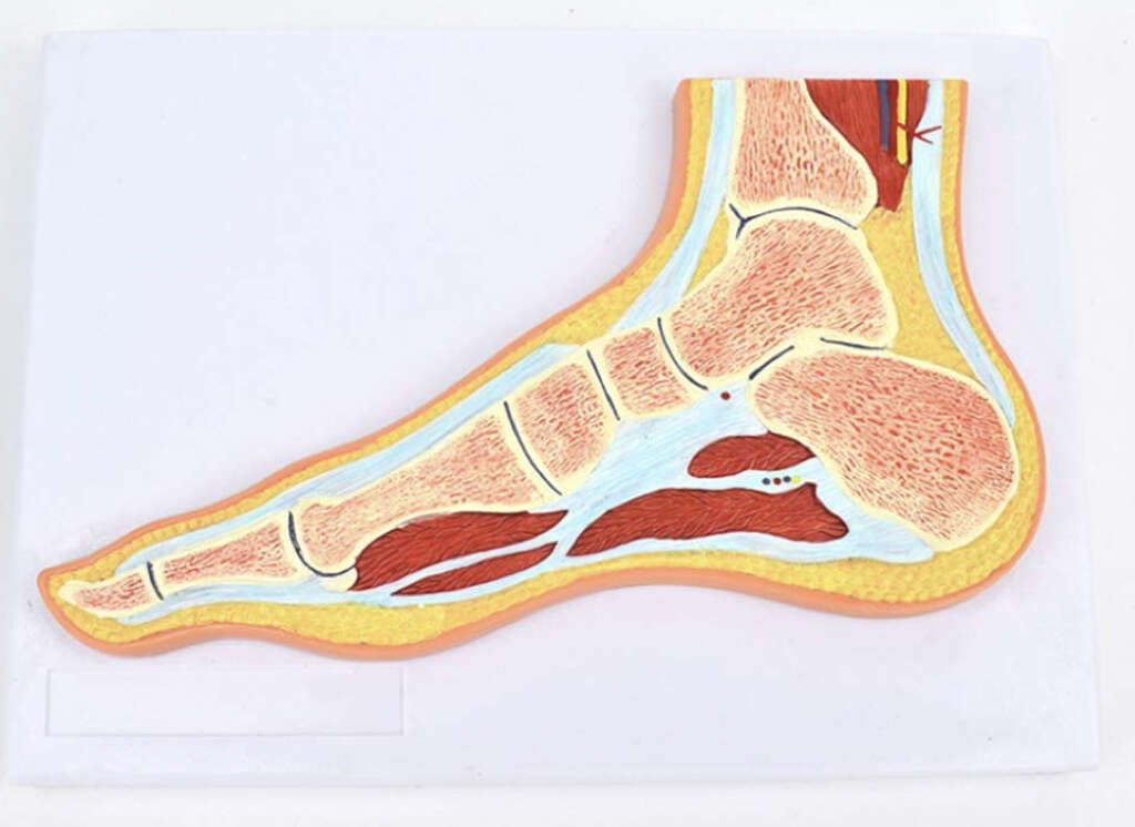 Hypermobility Syndrome: What Is Hypermobility Syndrome?