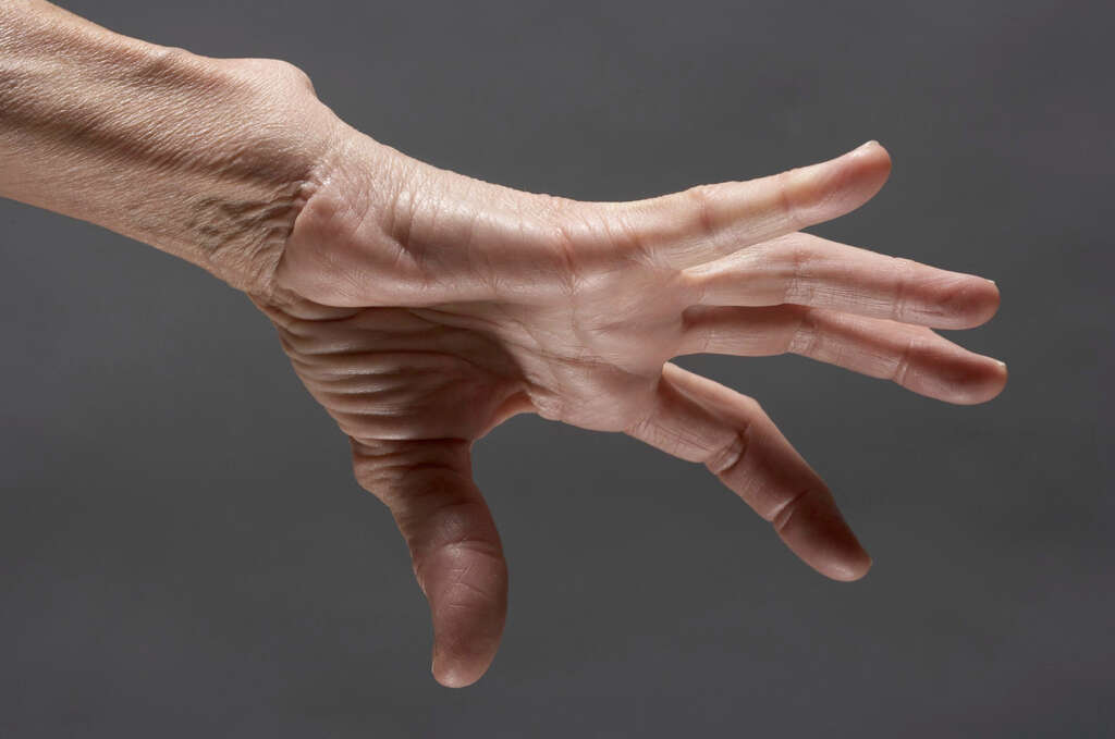 Hypermobility Syndrome
