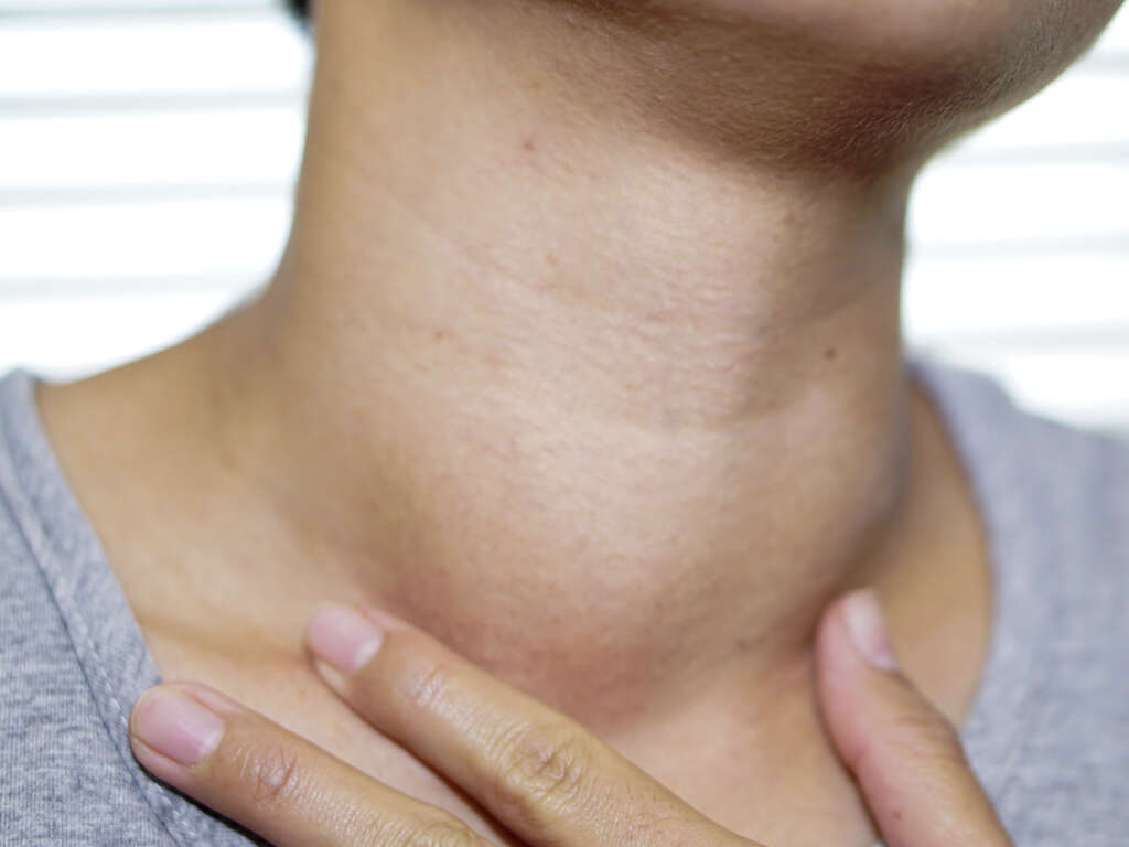 Hyperthyroidism