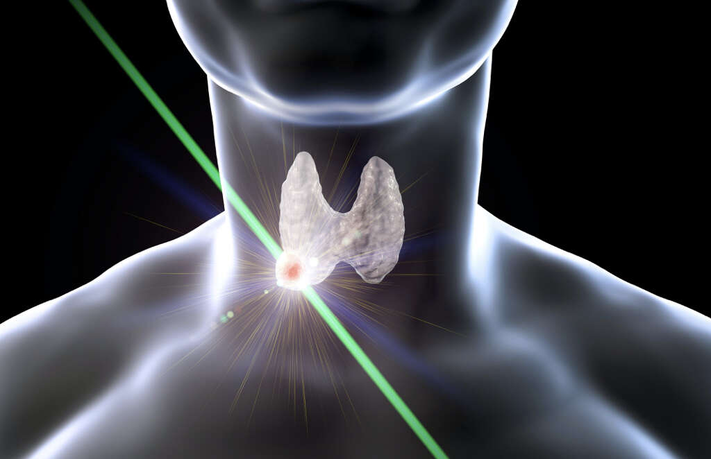 Hyperthyroidism