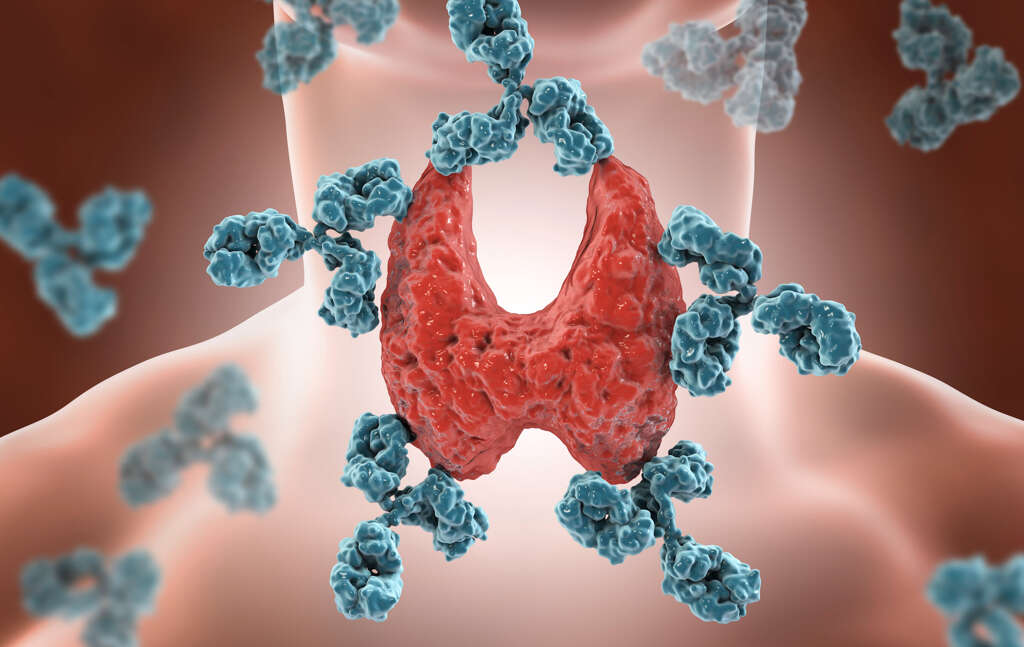 Hyperthyroidism