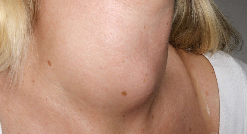 Hyperthyroidism