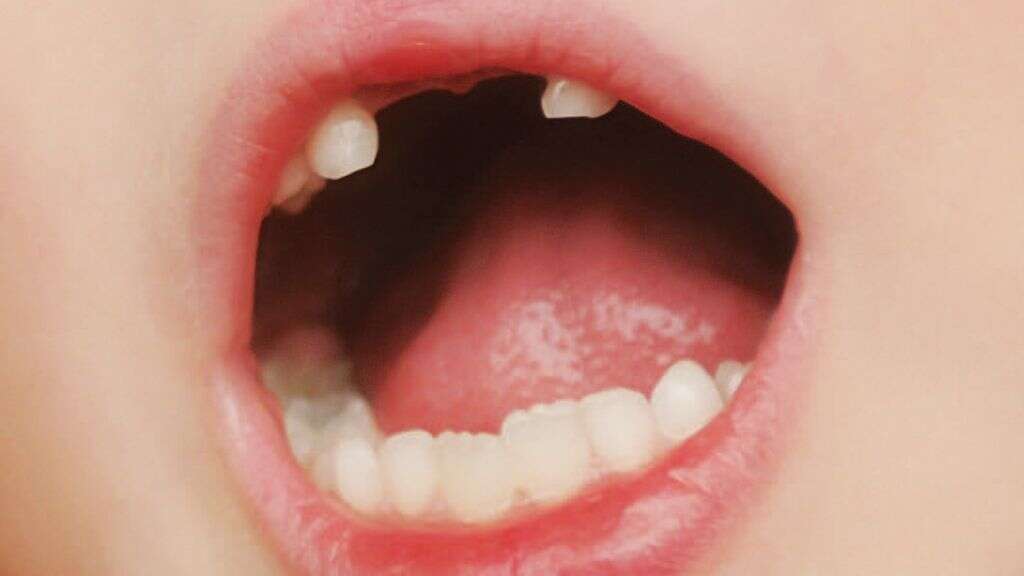 Hypophosphatasia