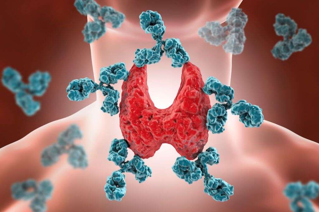 Hypothyroidism