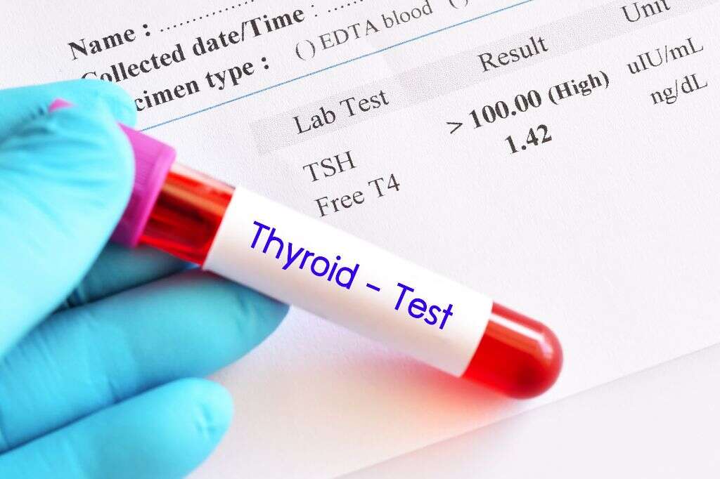Hypothyroidism