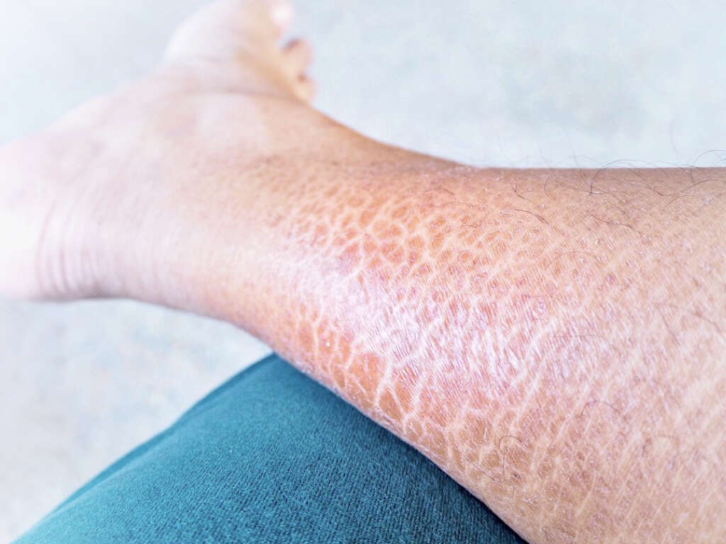 Ichthyosis