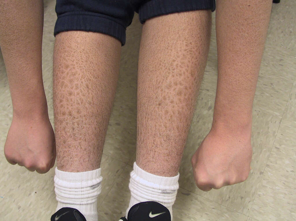 Ichthyosis