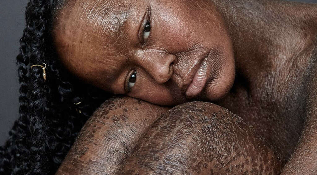 Ichthyosis