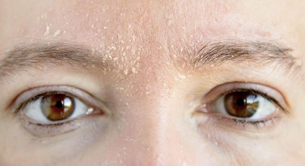 Ichthyosis
