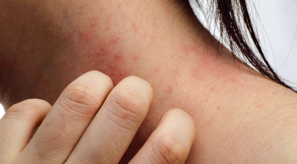 Impetigo